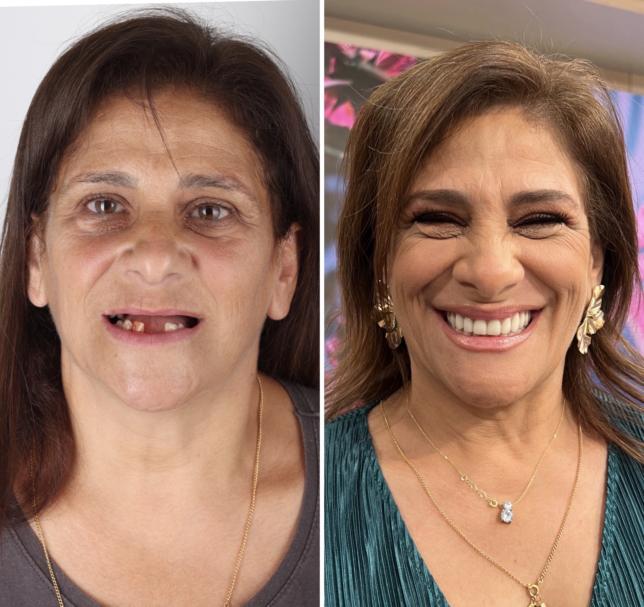 O novo sorriso da Ermelinda